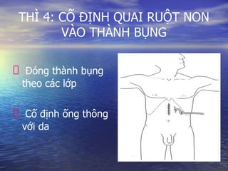 THÌ 4: CỐ ĐỊNH QUAI RUỘT NON
VÀO THÀNH BỤNG
Đóng thành bụng
theo các lớp
Cố định ống thông
với da
 