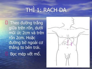 THÌ 1: RẠCH DA
Theo đường trắng
giữa trên rốn, dưới
mũi ức 2cm và trên
rốn 2cm. Hoặc
đường bờ ngoài cơ
thẳng to bên trái.
Bọc mép vết mổ.
 
