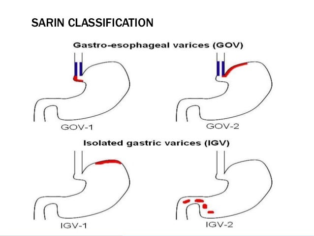 Oesophageal And Gastric Varices Classifications Oesophageal And Gastric Varices Classifications