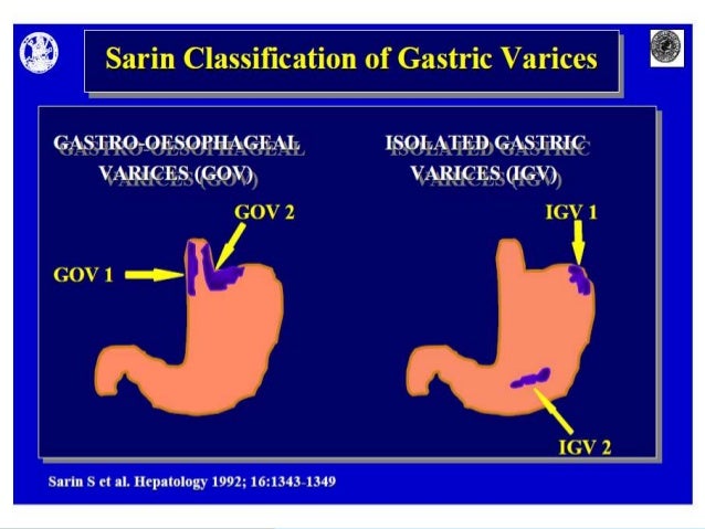 Oesophageal And Gastric Varices Classifications Oesophageal And Gastric Varices Classifications