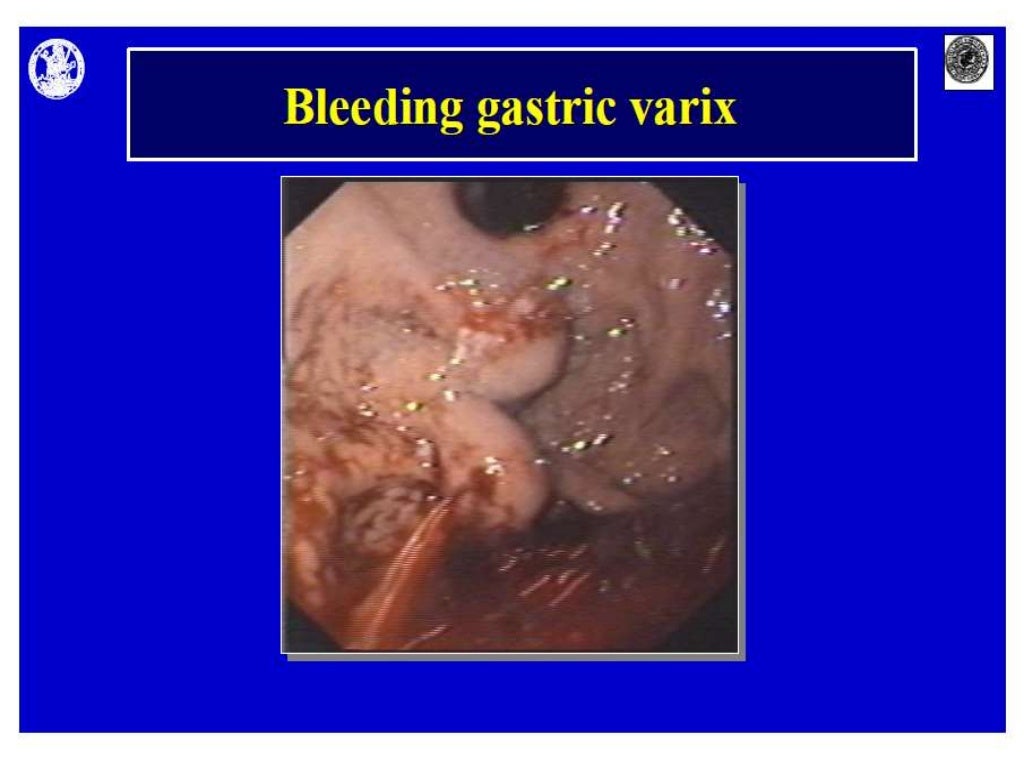 Oesophageal And Gastric Varices Classifications Oesophageal And Gastric Varices Classifications