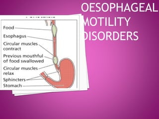 OESOPHAGEAL
MOTILITY
DISORDERS
 
