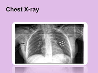 Chest X-ray
 