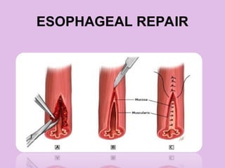 ESOPHAGEAL REPAIR
 