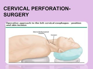 CERVICAL PERFORATION-
SURGERY
 