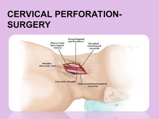 CERVICAL PERFORATION-
SURGERY
 