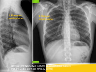 Q8: CXR #2: Name two features of oesophageal rupture
that are visible on these films. [2 points]
1. Pneumo-
mediastinum
2. Subcut
emphysema
 