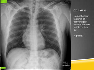 Q7: CXR #1
Name the four
features of
oesophageal
rupture that are
visible on this
film.
[4 points]
 