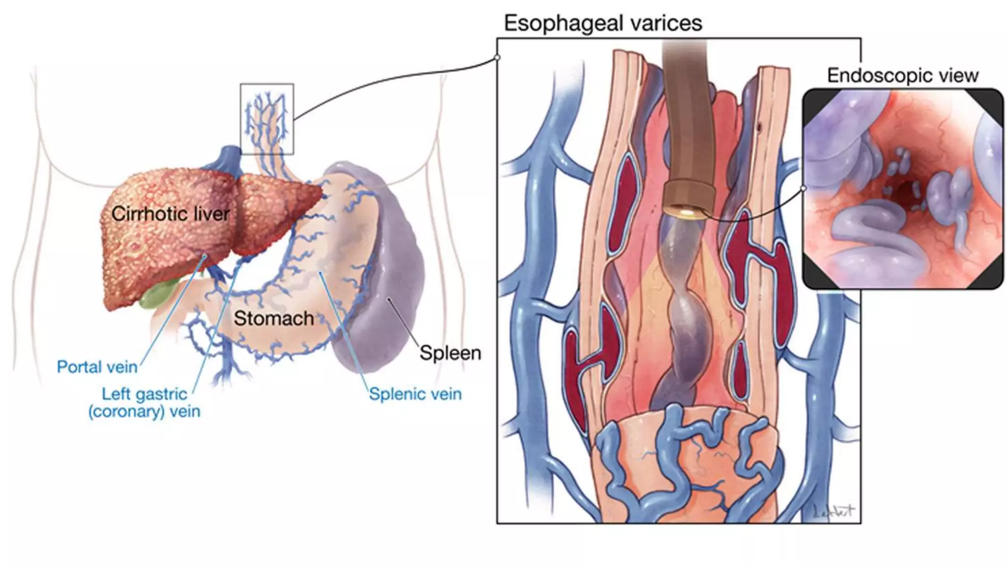 Varices Pathogenesis Oesophageal varices ppt slideshare | PPTX