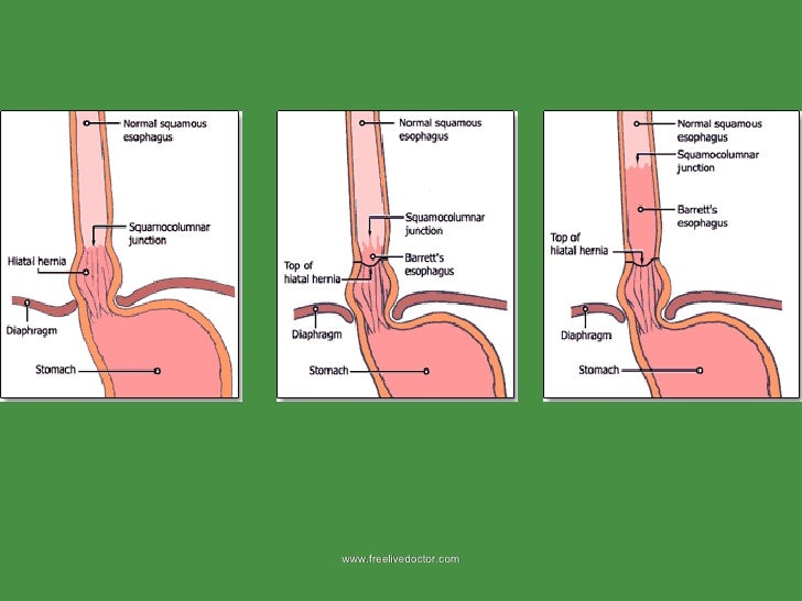 Oesophagous pathology