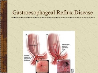 Gastroesophageal Reflux Disease
 