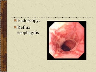 Endoscopy:
Reflux
esophagitis
 