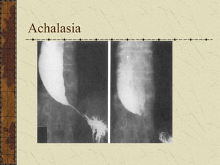 Achalasia
 
