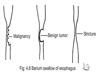 Malignancy Benign tumor Stricture
Fig: 4.8 Barium swallow of esophagus
 