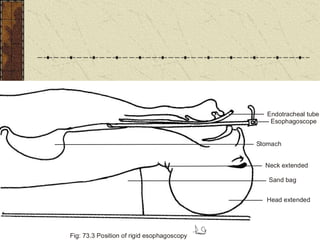 Endotracheal tube
Esophagoscope
Stomach
Neck extended
Sand bag
Head extended
Fig: 73.3 Position of rigid esophagoscopy
 