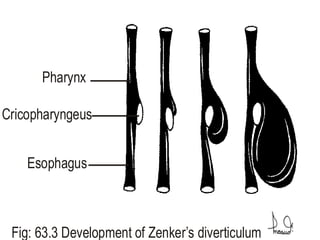 Pharynx
Cricopharyngeus
Esophagus
Fig: 63.3 Development of Zenker’s diverticulum
 