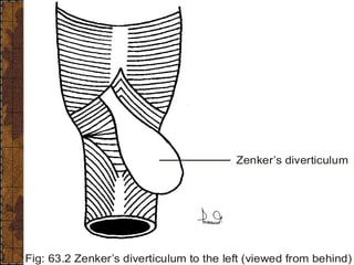 Zenker’s diverticulum
Fig: 63.2 Zenker’s diverticulum to the left (viewed from behind)
 