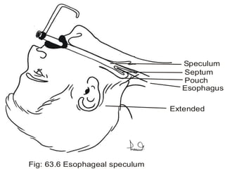 Speculum
Septum
Pouch
Esophagus
Extended
Fig: 63.6 Esophageal speculum
 
