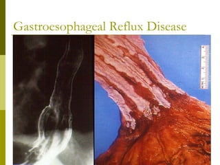 Gastroesophageal Reflux Disease
 