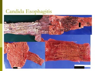Candida Esophagitis
 