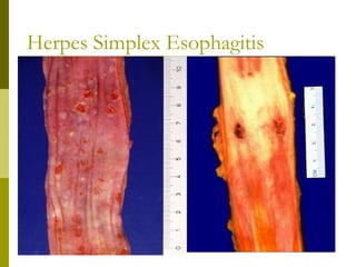 Herpes Simplex Esophagitis
 