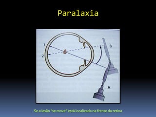 Paralaxia
 