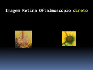 Imagem Retina Oftalmoscópio direto
 