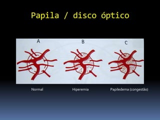 Papila / disco óptico




Normal   Hiperemia   Papiledema (congestão)
 