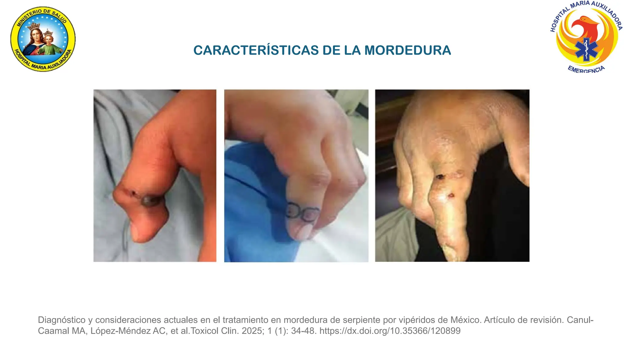 Diagnóstico y consideraciones actuales en el tratamiento en mordedura de serpiente por vipéridos de México. Artículo de revisión. Canul-
Caamal MA, López-Méndez AC, et al.Toxicol Clin. 2025; 1 (1): 34-48. https://dx.doi.org/10.35366/120899
CARACTERÍSTICAS DE LA MORDEDURA
 