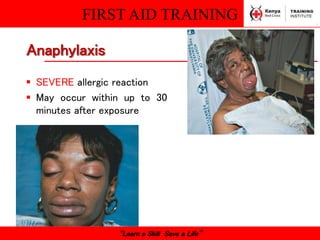 FIRST AID TRAINING
“Learn a Skill Save a Life”
 SEVERE allergic reaction
 May occur within up to 30
minutes after exposure
Anaphylaxis
 