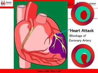 FIRST AID TRAINING
“Learn a Skill Save a Life”
)Heart Attack
(Blockage of
Coronary Artery
 