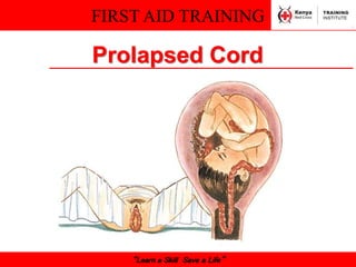 FIRST AID TRAINING
“Learn a Skill Save a Life”
Prolapsed Cord
 