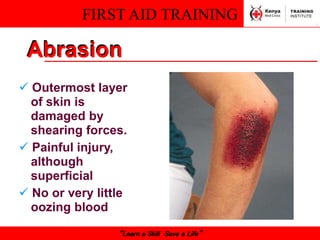 FIRST AID TRAINING
“Learn a Skill Save a Life”
Abrasion
 Outermost layer
of skin is
damaged by
shearing forces.
 Painful injury,
although
superficial
 No or very little
oozing blood
 