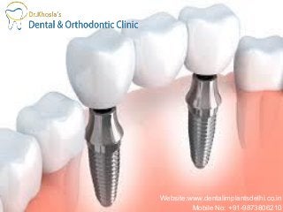 Website:www.dentalimplantsdelhi.co.in
Mobile No: +91-9873806210
 
