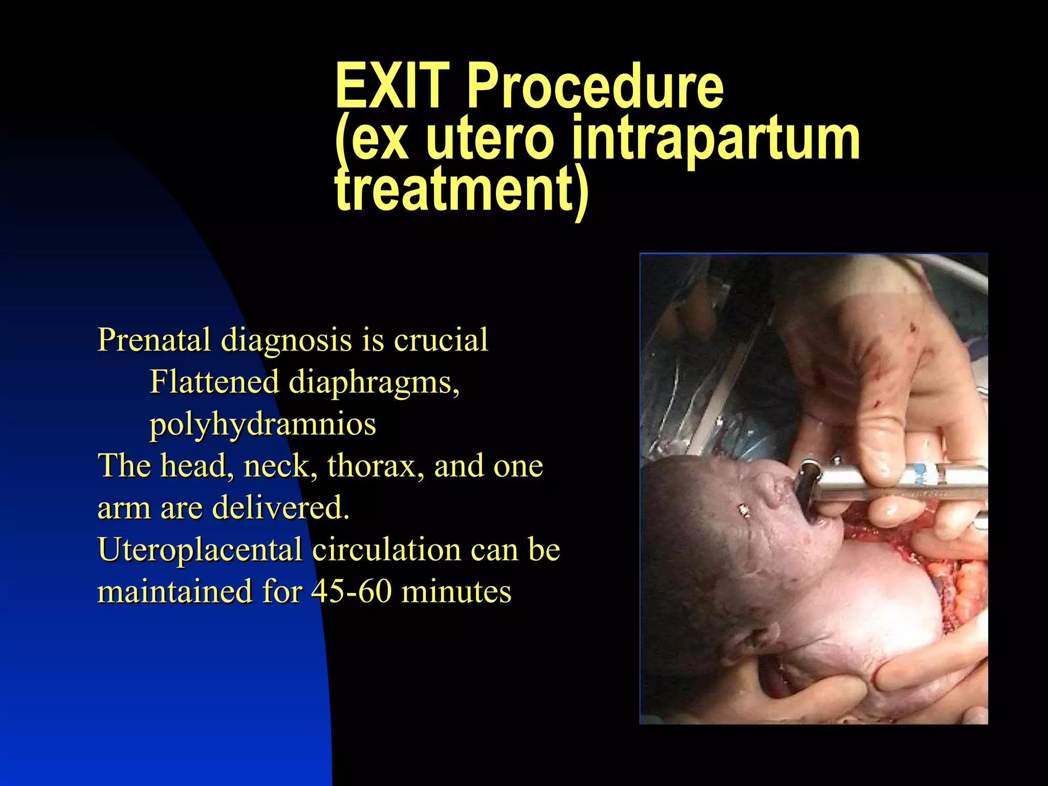 EXIT Procedure (ex utero intrapartum treatment) Prenatal diagnosis is crucial Flattened diaphragms, polyhydramnios The head, neck, thorax, and one arm are delivered. Uteroplacental circulation can be maintained for 45-60 minutes 