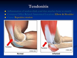 Tendonitis
Inflammation of tendon-thick cord that attaches bone to muscle
Common Office Related Anatomical Location: Elbow & Shoulder
Cause: Repetitive motion
 