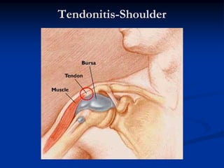 Tendonitis-Shoulder
 