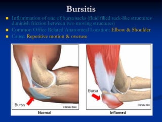 Bursitis
Inflammation of one of bursa sacks (fluid filled sack-like structures
diminish friction between two moving structures)
Common Office Related Anatomical Location: Elbow & Shoulder
Cause: Repetitive motion & overuse
 