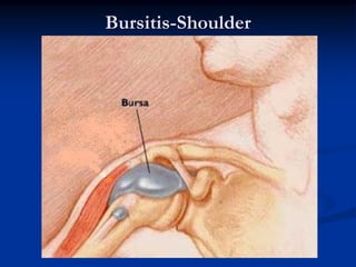 Bursitis-Shoulder
 