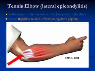 Tennis Elbow (lateral epicondylitis)
Inflammation of the tendons outside (lateral side) of the elbow
Cause: Repetitive motion of wrists or repetitive gripping
 