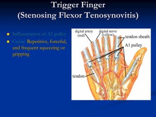 Trigger Finger
  (Stenosing Flexor Tenosynovitis)

Inflammation of A1 pulley
Cause: Repetitive, forceful,
and frequent squeezing or
gripping
 