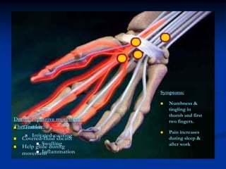 Symptoms:

                                 Numbness &
                                 tingling in
                                 thumb and first
During repetitive movement:      two fingers.
The Tendon:
   Tendons
                                 Pain increases
       Irritated-causing
   Covered-fluid sheath          during sleep &
            Swelling             after work
   Help glide during
   movement Inflammation
 