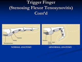 Trigger Finger
(Stenosing Flexor Tenosynovitis)
             Cont’d




 NORMAL ANATOMY    ABNORMAL ANATOMY
 