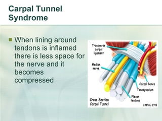 Carpal Tunnel Syndrome When lining around tendons is inflamed there is less space for the nerve and it becomes compressed 