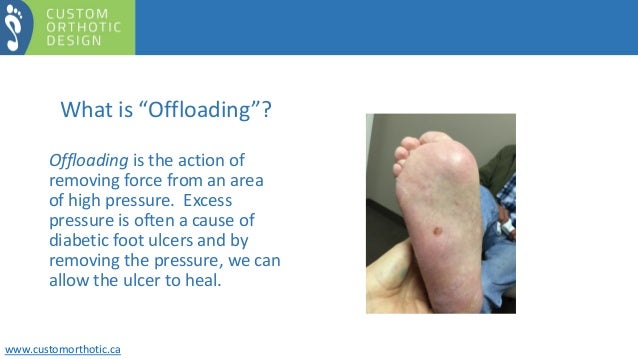 Offloading The Diabetic Foot