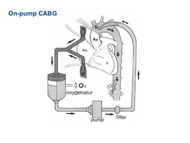 renal function after off pump cabg journal club