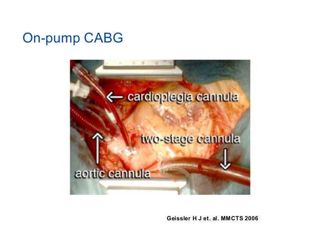 renal function after off pump cabg journal club