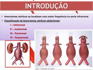 Aneurisma de Aorta | PPTX