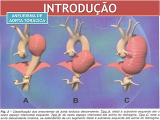 Aneurisma de Aorta | PPTX