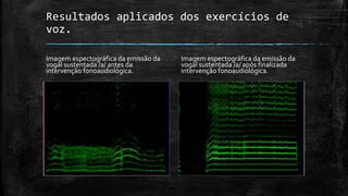 Resultados aplicados dos exercícios de
voz.
Imagem espectográfica da emissão da
vogal sustentada /a/ antes da
intervenção fonoaudiológica.
Imagem espectográfica da emissão da
vogal sustentada /a/ após finalizada
intervenção fonoaudiológica.
 